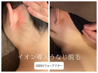 🎀うなじ脱毛🎀 ㅣLino堀江のエステ・リラクイメージ
