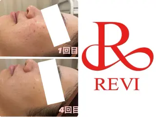 よもぎ蒸しピーリング Lupinusのエステ・リラクイメージ