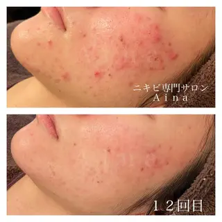 セミロング パーマ ヘアアレンジ メンズ キッズ ネイル マツエク・マツパ ニキビ跡専門サロン Ainaのエステ・リラクイメージ