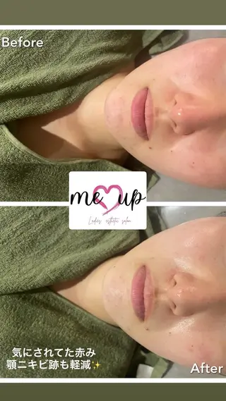 Meupニキビ専門店 背中/ハーブ/肌管理のその他イメージ