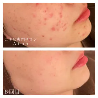 セミロング カラー パーマ ヘアアレンジ メンズ キッズ ネイル マツエク・マツパ ニキビ跡専門サロン Ainaのエステ・リラクイメージ