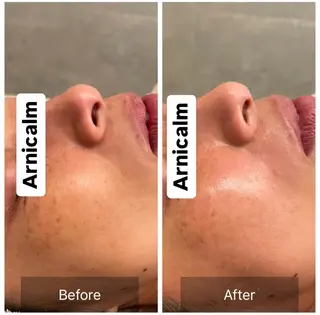 ハーブピーリング 肌再生ピーリング/のエステ・リラクイメージ