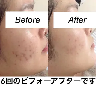 ミディアム カラー パーマ ヘアアレンジ ネイル マツエク・マツパ 都度払い肌質改善 &脱毛Blancheのエステ・リラクイメージ