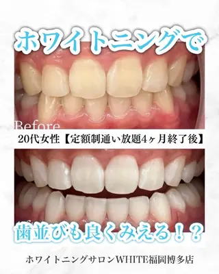 キッズ メンズ セルフホワイトニング WHITE福岡博多店のエステ・リラクイメージ