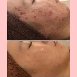 セミロング カラー パーマ ヘアアレンジ メンズ キッズ ネイル マツエク・マツパ アイブロウ 3か月で肌革命👼 ニキビ専門店💫のエステ・リラクイメージ