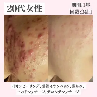 ニキビ・肌質改善専門 ♡人生が変わるサロンのエステ・リラクイメージ