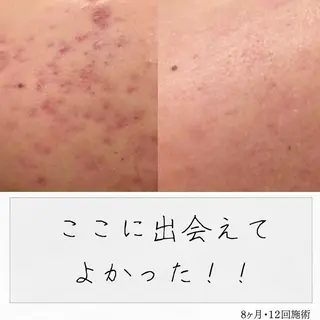ニキビ経験者が施術 する専門サロン🌻のエステ・リラクイメージ