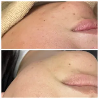 ニキビ/敏感肌/乾燥 Lilyauraのエステ・リラクイメージ