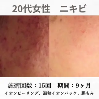 重度ニキビ専門🌷 ダウンタイムなしのエステ・リラクイメージ