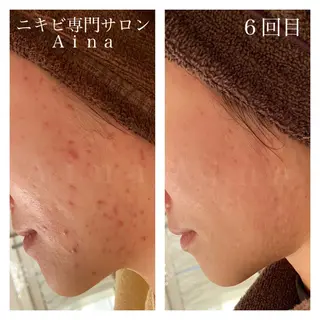 セミロング カラー パーマ ヘアアレンジ メンズ キッズ ネイル マツエク・マツパ ニキビ跡専門サロン Ainaのエステ・リラクイメージ