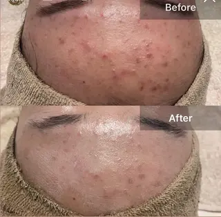 安心の看護師施術 ニキビ改善HAONのエステ・リラクイメージ