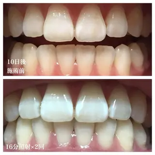 ネイル/耳つぼ /新ホワイトニングのネイルデザイン