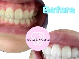 セルフホワイトニング kiharuのその他イメージ