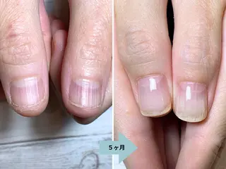 ネイル 深爪矯正・自爪育成 ネイルサロンアモここのネイルデザイン