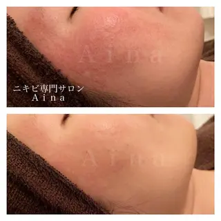 ロング カラー パーマ ヘアアレンジ メンズ マツエク・マツパ アイブロウ ニキビ跡専門サロン Ainaのエステ・リラクイメージ