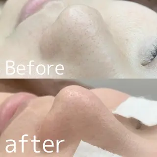 【美容鍼・小顔鍼】 鍼灸師　吉田洋美のエステ・リラクイメージ