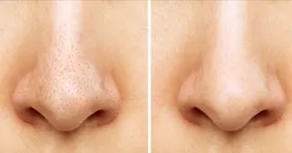 肌質改善BIOELプ ラズマ/ラミピールのエステ・リラクイメージ