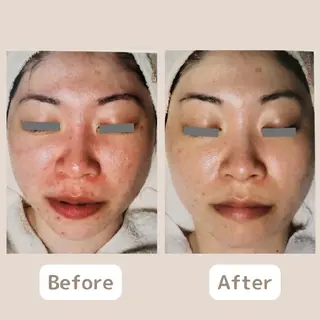 〈ニキビケアサロン〉 レゾン京橋店/ 浅川のエステ・リラクイメージ