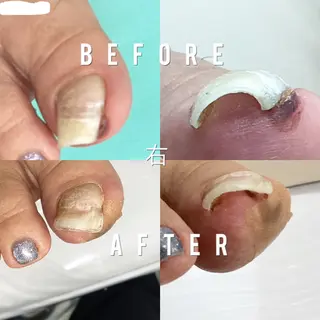 巻き爪補正店 大阪なんば店のネイルデザイン