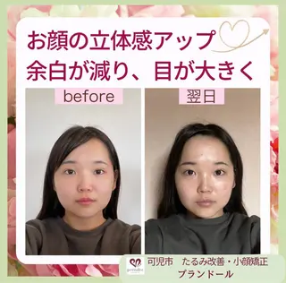 リフトアップ小顔 プランドール所属・痛くない小顔矯正 いまいあやののその他イメージ