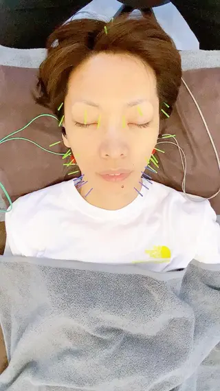 印象の良くなる 美容鍼のエステ・リラクイメージ