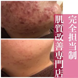 3か月で肌革命👼 ニキビ専門店💫のエステ・リラクイメージ