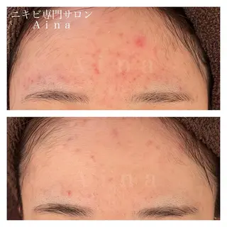 セミロング パーマ ヘアアレンジ メンズ キッズ ネイル マツエク・マツパ アイブロウ ニキビ跡専門サロン Ainaのエステ・リラクイメージ