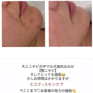 ニキビ/敏感肌/乾燥 Lilyauraのエステ・リラクイメージ