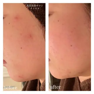 セミロング カラー パーマ ヘアアレンジ メンズ キッズ ネイル マツエク・マツパ ニキビ跡専門サロン Ainaのエステ・リラクイメージ