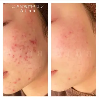 セミロング パーマ ヘアアレンジ メンズ キッズ ネイル マツエク・マツパ アイブロウ ニキビ跡専門サロン Ainaのエステ・リラクイメージ