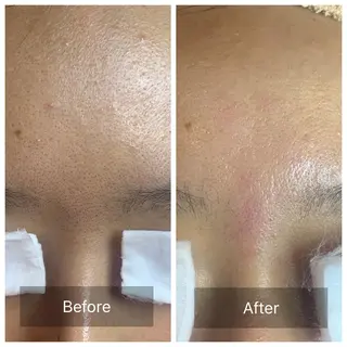 ielu〜毛穴ケア ハーブピーリングのエステ・リラクイメージ