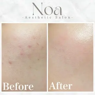 肌質改善サロン Noaのエステ・リラクイメージ