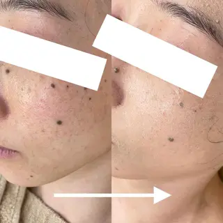 グリーンピール専門店 🌿エルモナのエステ・リラクイメージ