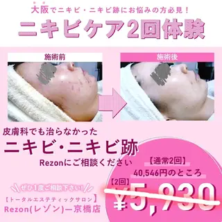 〈ニキビケアサロン〉 レゾン京橋店/ 浅川のエステ・リラクイメージ