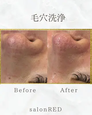 WAX・肌質改善・毛 穴洗浄/林愛真のエステ・リラクイメージ