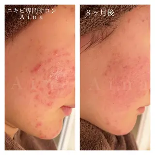 セミロング パーマ ヘアアレンジ メンズ キッズ ネイル マツエク・マツパ アイブロウ ニキビ跡専門サロン Ainaのエステ・リラクイメージ