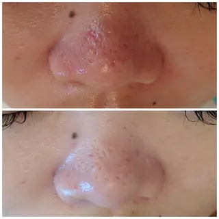 【赤ニキビ改善】 BELL'ET新宿店のエステ・リラクイメージ