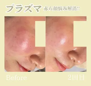 WAX・肌質改善・毛 穴洗浄/林愛真のエステ・リラクイメージ