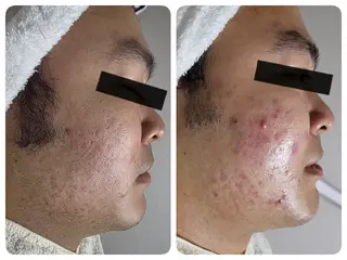 メンズ 〈ニキビケアサロン〉 レゾン京橋店/ 浅川のエステ・リラクイメージ