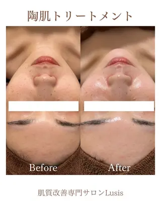 フェイシャルサロンLusis所属・肌質改善専門サロン Lusisのエステ・リラクイメージ