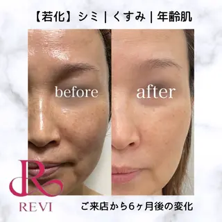 REVIハーブピーリング/バストケア/脱毛 Retea.【ルテア】所属・ハーブピーリング| 毛穴洗浄|ルテアのエステ・リラクイメージ