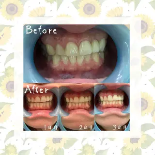 セルフホワイトニング 『Luster』のその他イメージ