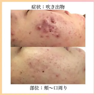 3か月で肌革命👼 ニキビ専門店💫のエステ・リラクイメージ