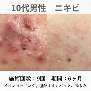 重度ニキビ専門🌷 ダウンタイムなしのエステ・リラクイメージ