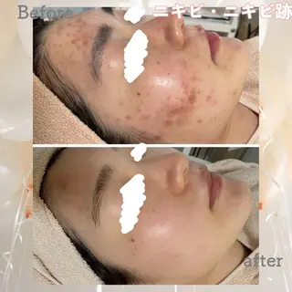 ニキビ&跡改善サロン オーナー光木のエステ・リラクイメージ