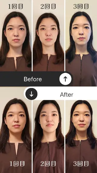 即効⚡小顔美容鍼🪡 むくみたるみ脂肪解消のエステ・リラクイメージ