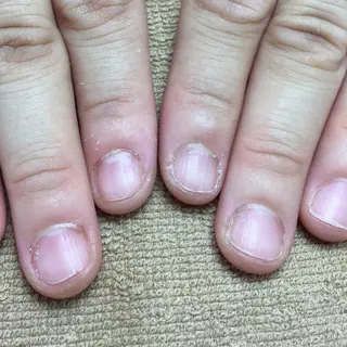 ネイル 深爪矯正/爪育成ケア manie nailのネイルデザイン