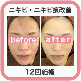3か月で肌革命👼 ニキビ専門店💫のエステ・リラクイメージ