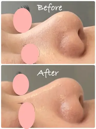 肌質改善ハーブピーリング専門Loy所属・Loy(ロイ)🍀 ハーブピーリング🌈のエステ・リラクイメージ