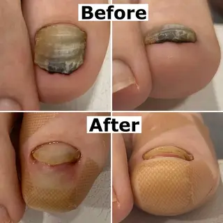 ネイル Mellow nail所属・巻爪無料モデル募集 ✨🦶MEGUMIのネイルデザイン